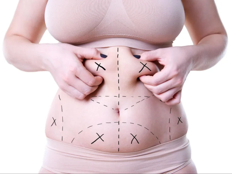 Understanding the Liposuction Procedure: A complete Guide