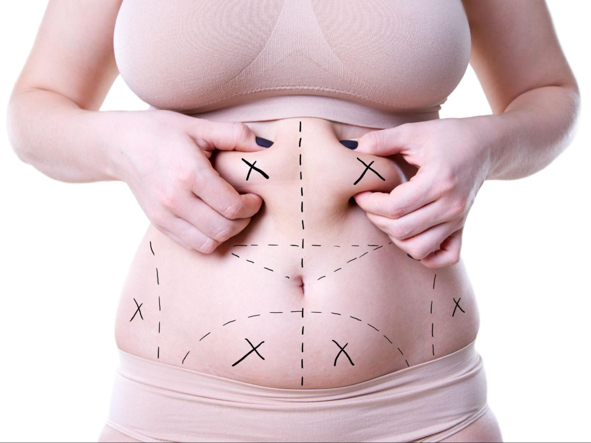 Understanding the Liposuction Procedure: A complete Guide