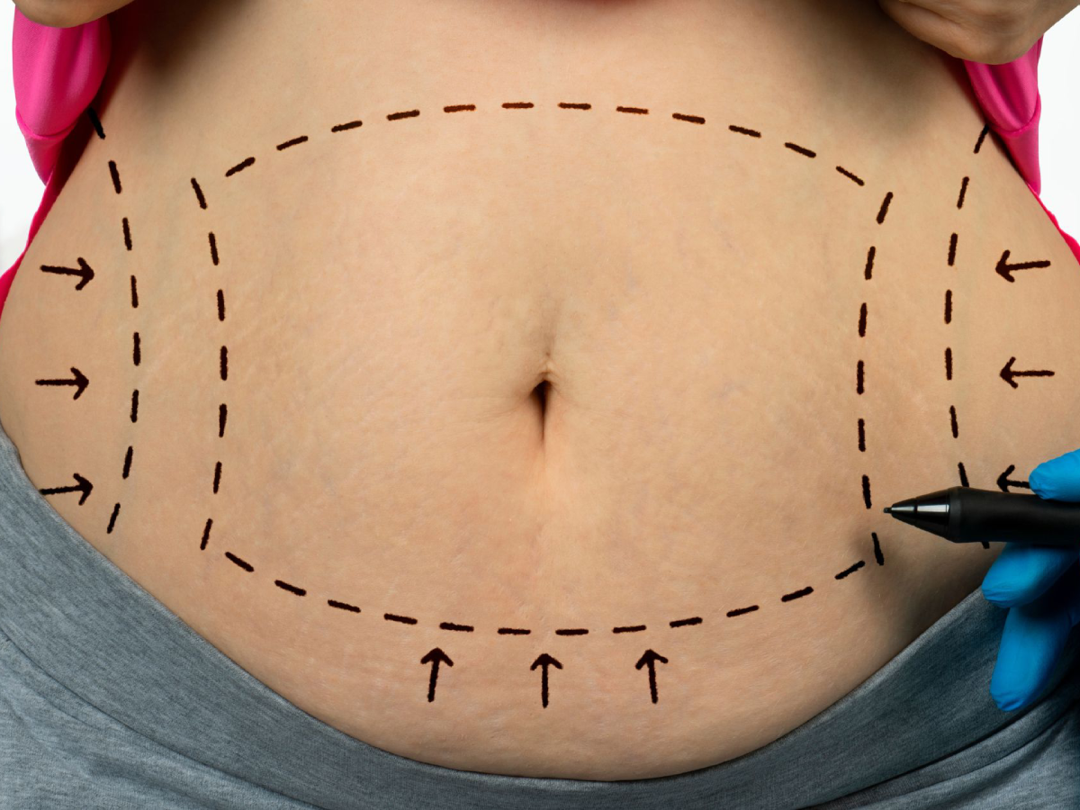 Traditional Liposuction