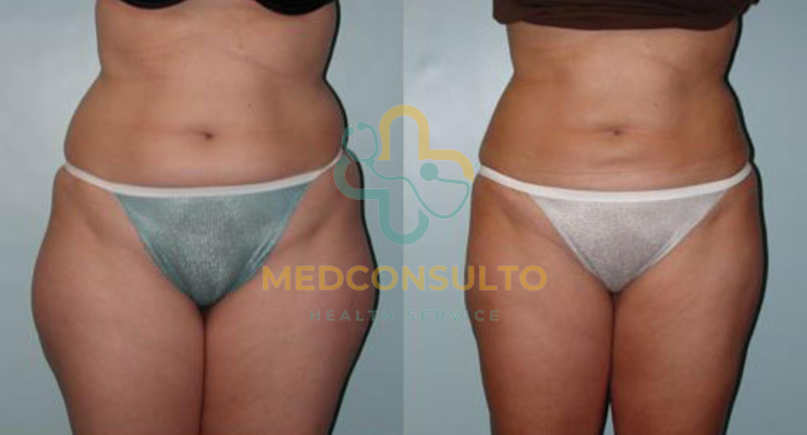 liposuction surgery before and after Case