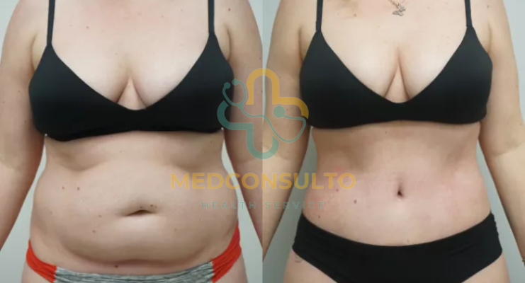 liposuction surgery before and after Case 2