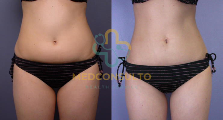 liposuction surgery before and after Case 4