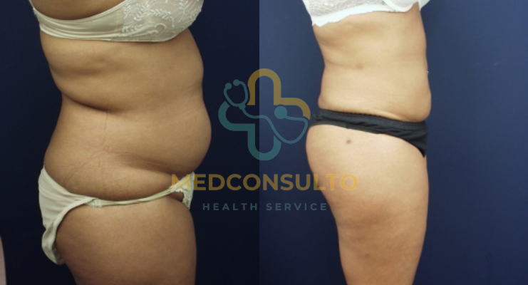 liposuction surgery before and after Case 6