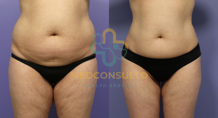 liposuction surgery before and after Case 8