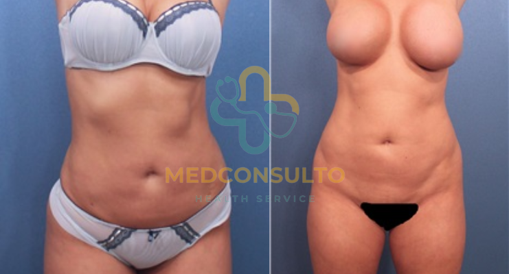 liposuction surgery before and after Case 1