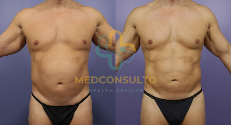 liposuction surgery man before and after Case 2