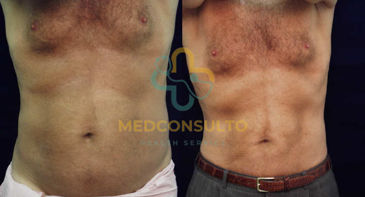 liposuction surgery man before and after Case 1