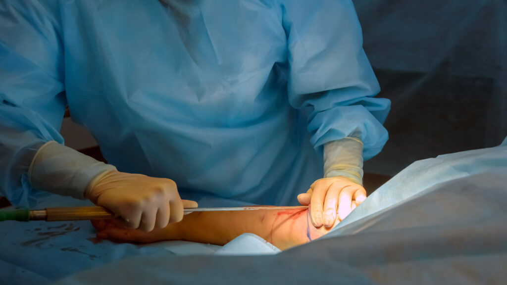 Arm liposuction procedure
