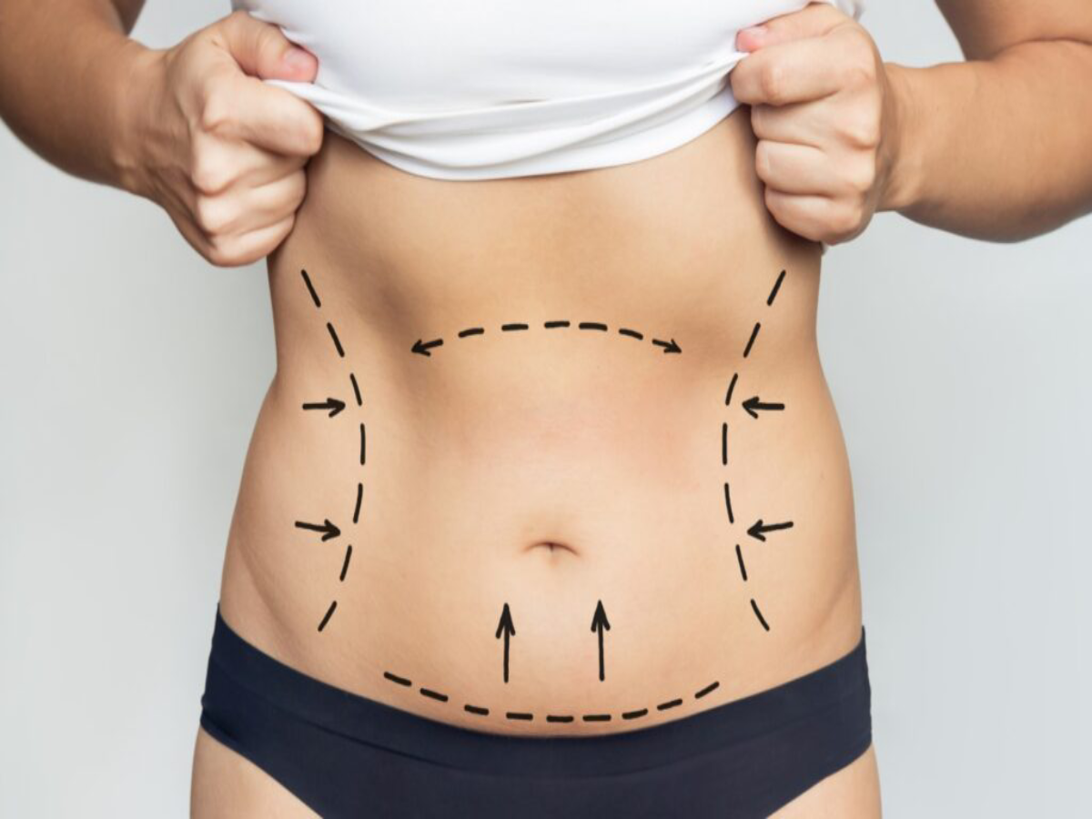 Recovery after laser liposuction: What To Expect?