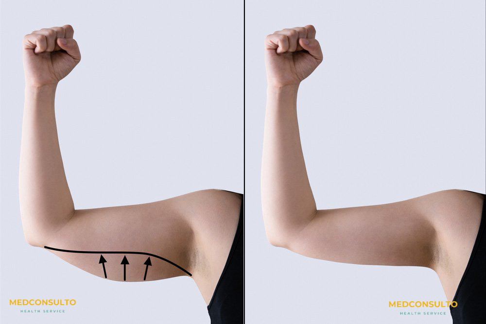 arm-liposuction-surgery-before-after