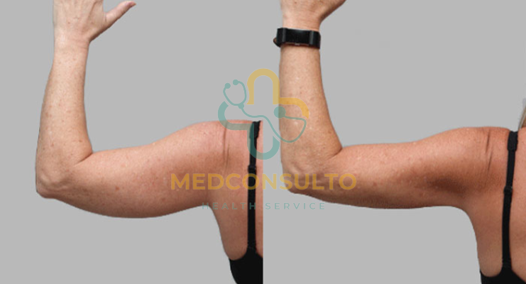 vaser liposuction arms before and after