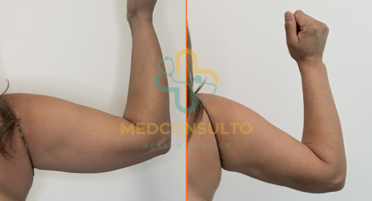 vaser liposuction arms before and after