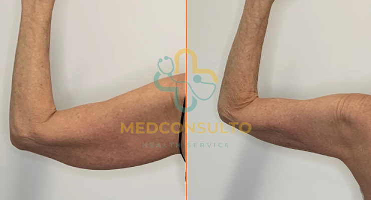 vaser liposuction arms before and after