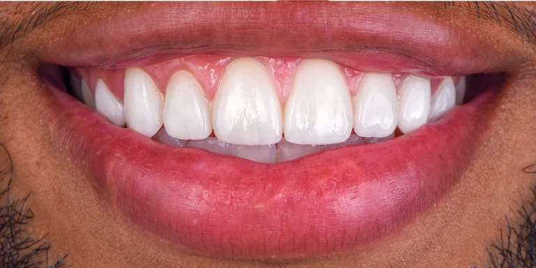 Before & After Cosmetic dentistry (1)