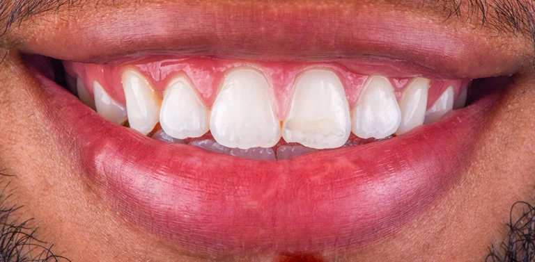 Before & After Cosmetic dentistry