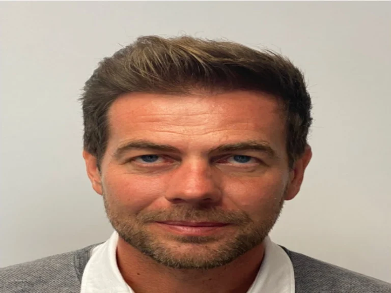 Before & after Hair Transplant (1)