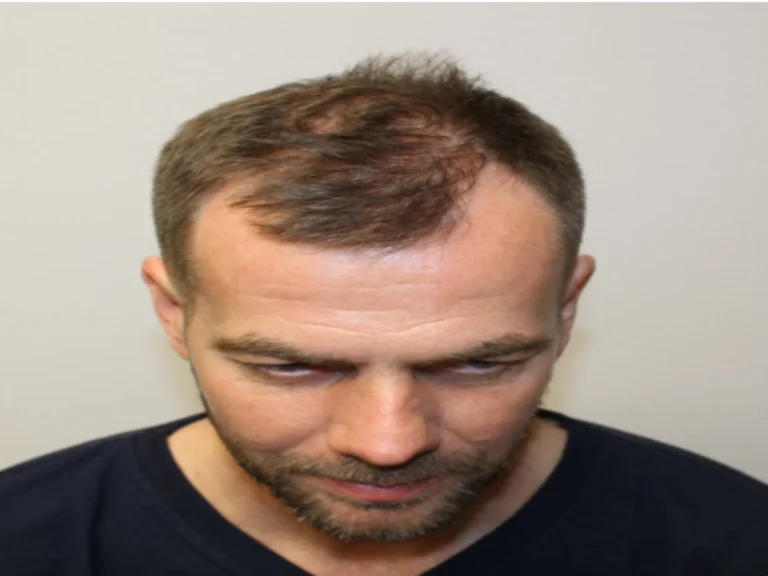 Before & after Hair Transplant
