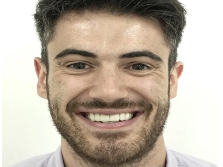 Dental Implants Before & After (1)