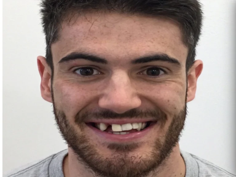 Dental Implants Before & After (2)