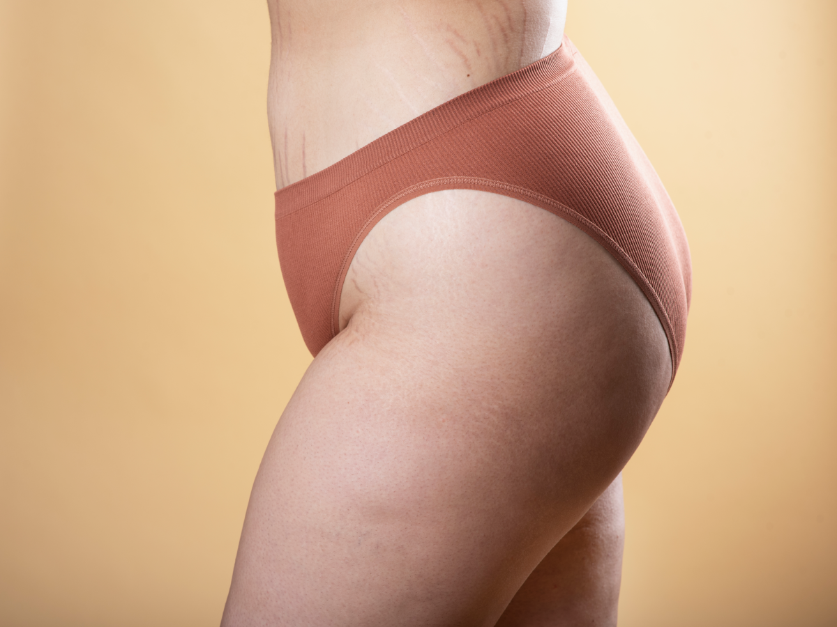 What is Inner & Outer Thigh Liposuction?