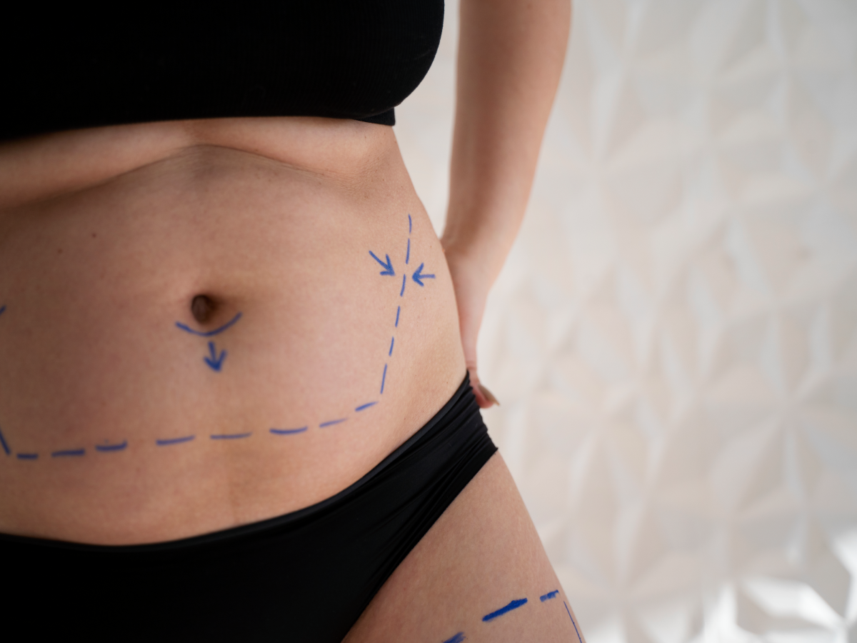 What is tummy tuck surgery?