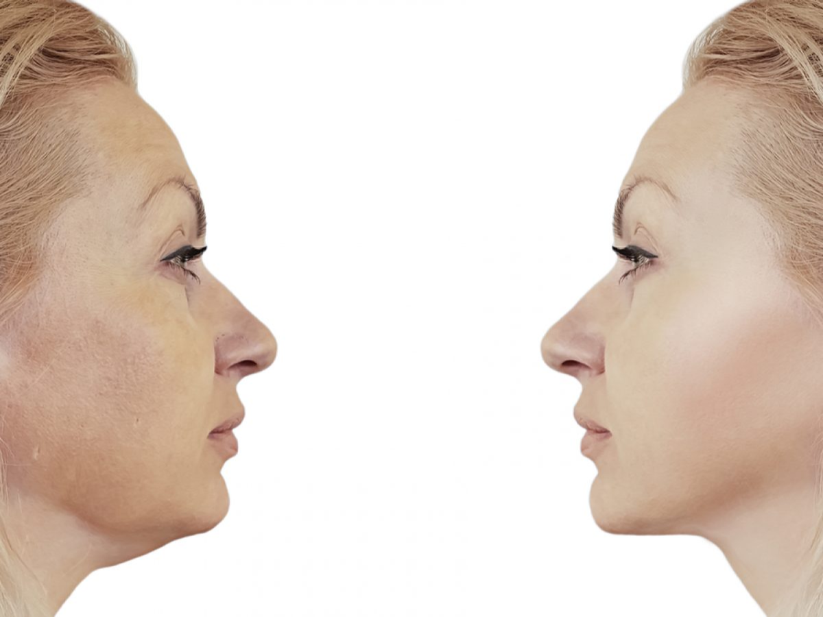 Kybella Aftercare:10 Expert Tips to Enhance Healing