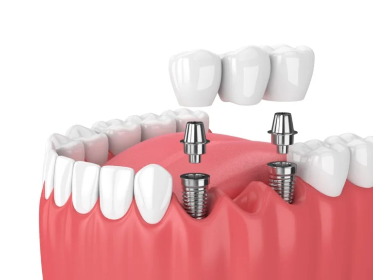 Teeth Replacement: dental implant