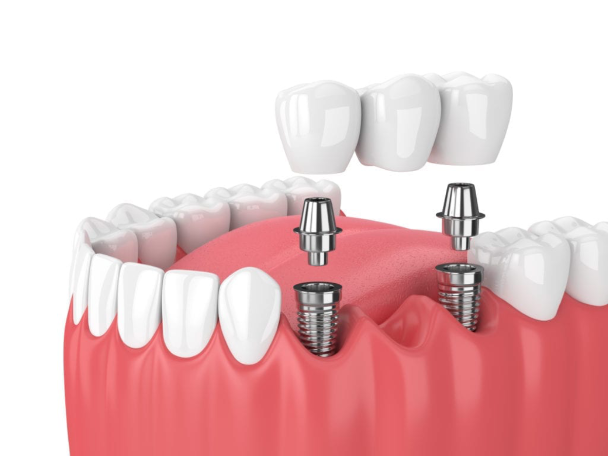 Teeth Replacement: dental implant