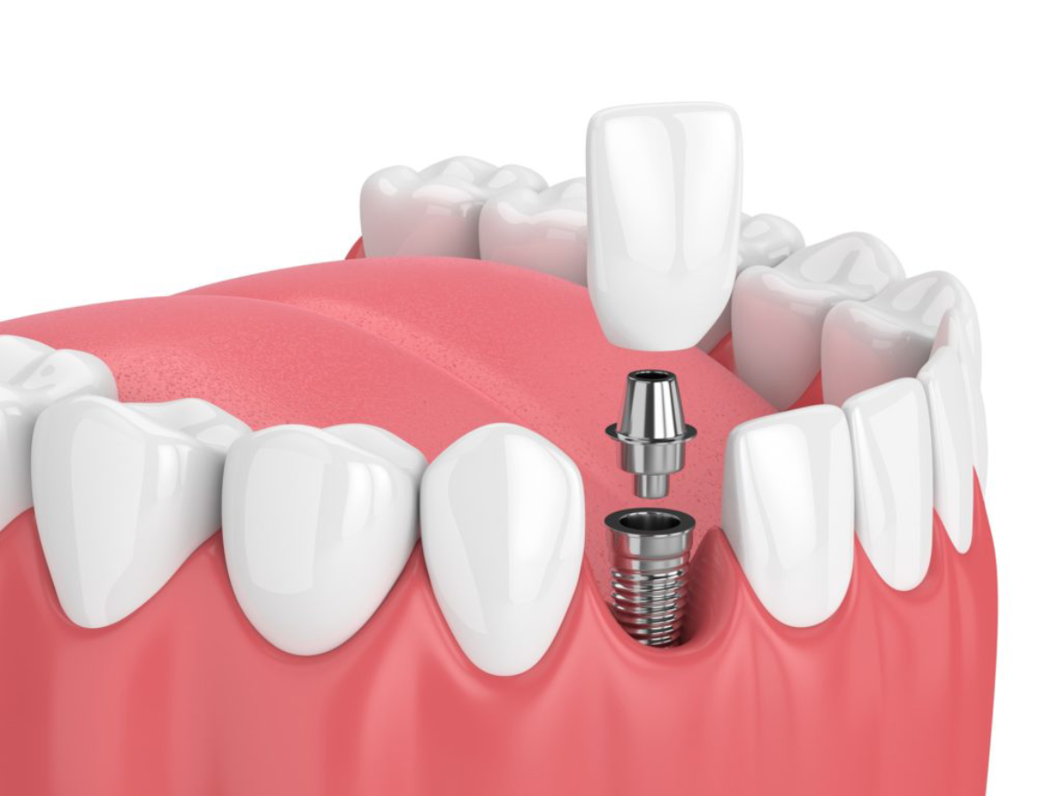 Types of Dental Implants