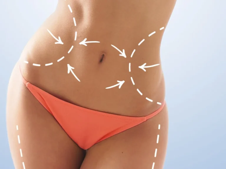 Factors affecting Vaser Liposuction cost