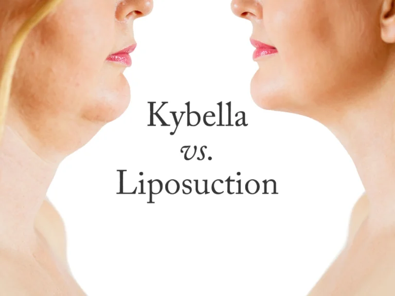 Side-by-side comparison of a woman's chin before and after treatment, showing the difference between Kybella and liposuction for double chin reduction.