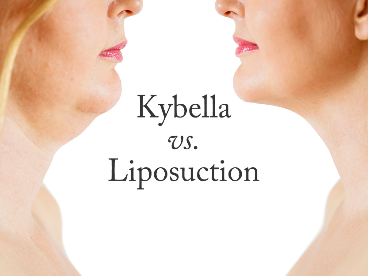 Side-by-side comparison of a woman's chin before and after treatment, showing the difference between Kybella and liposuction for double chin reduction.