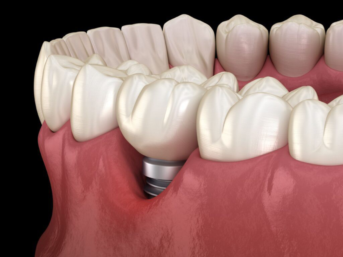 10 Side Effects of Dental Implants: What You Need to Know