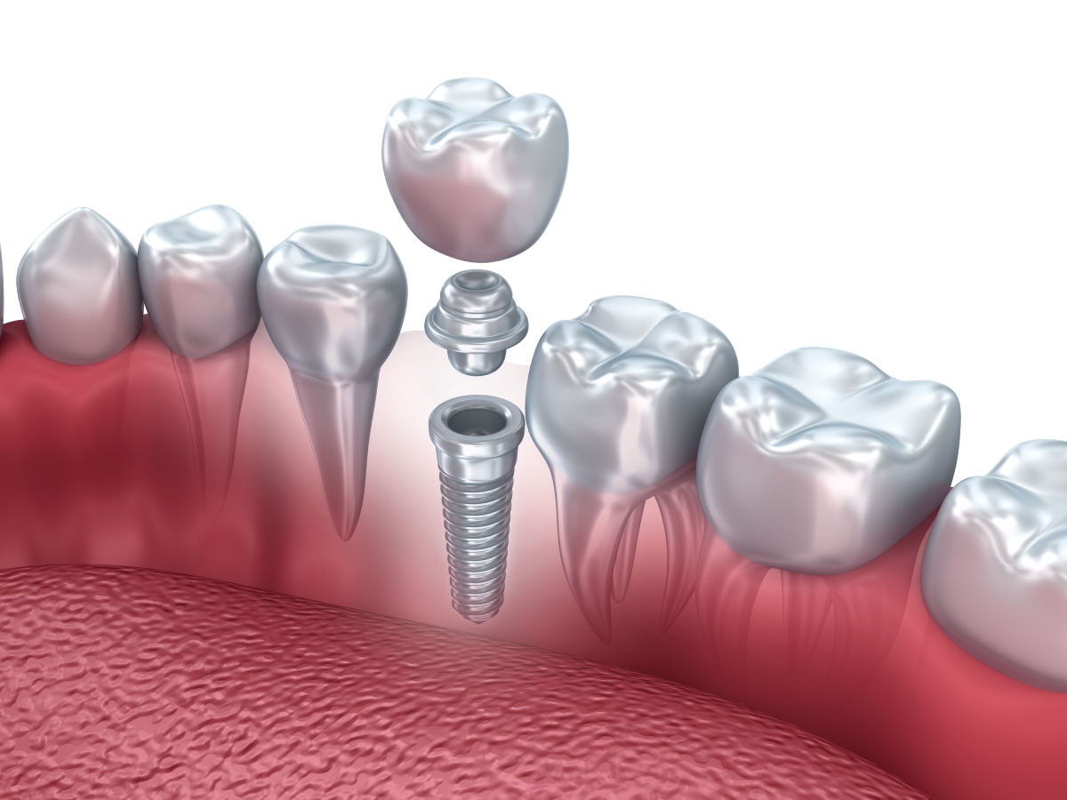 Dental Implants Recovery