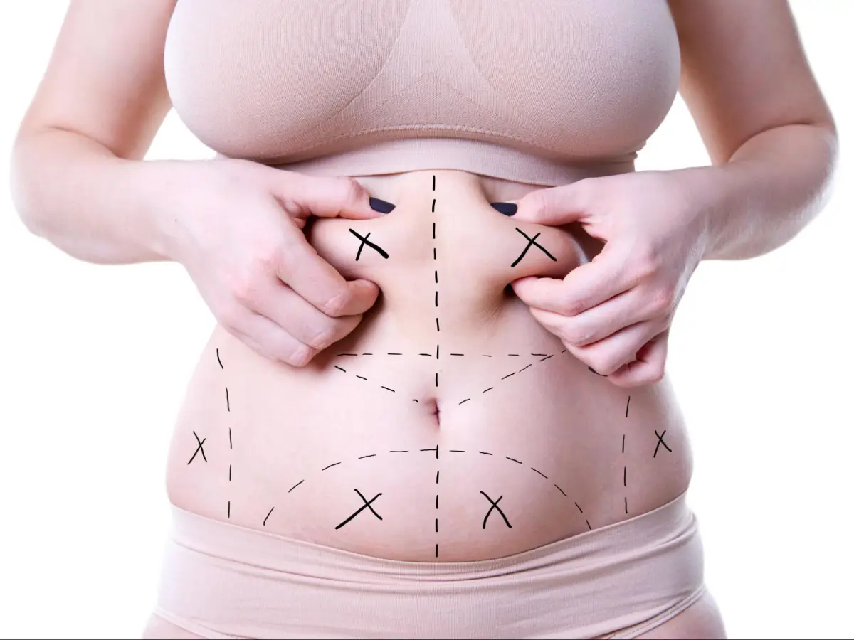 Stomach Liposuction Procedure