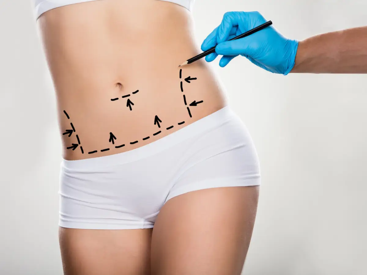 standard tummy tuck