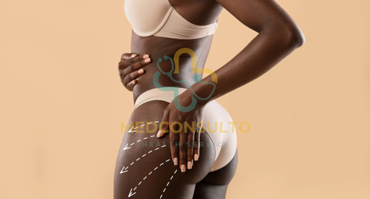 Brazilian Butt Lift Recovery: Side view showing post-operative massage directions marked