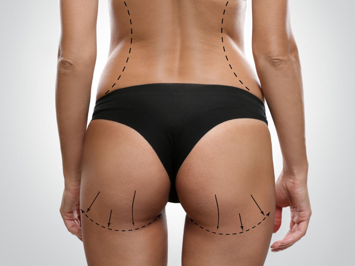 Surgical markings showing planned incision lines for Brazilian butt lift procedure on patient