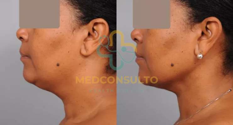 Neck Liposuction Before and After