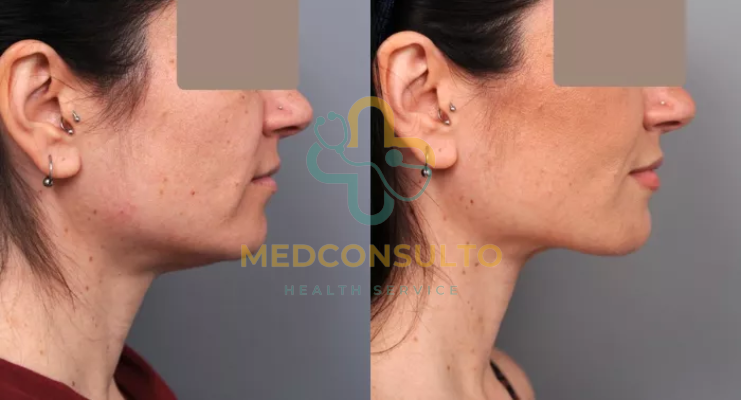 Neck Liposuction Before and After