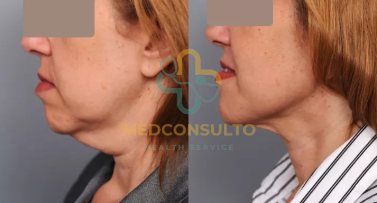 Neck Liposuction Before and After