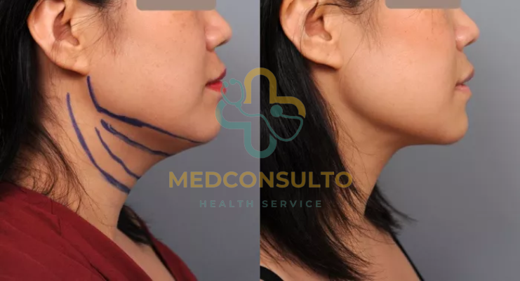 Neck Liposuction Before and After