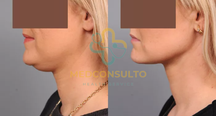 Neck Liposuction Before and After