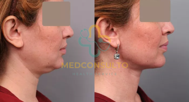 Neck Liposuction Before and After