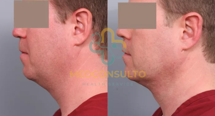 Neck Liposuction Before and After