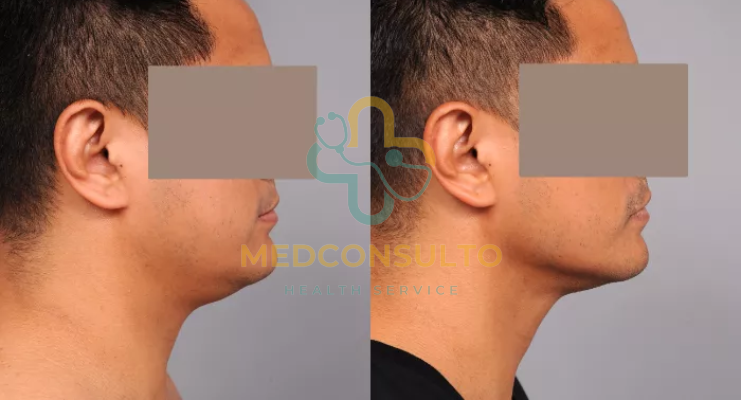 Neck Liposuction Before and After