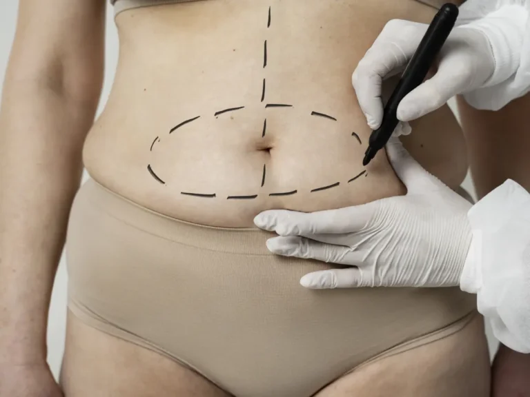Abdominal Liposuction