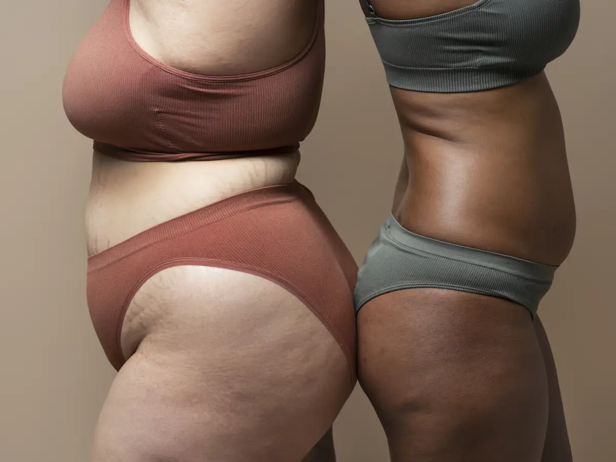 panniculectomy vs tummy tuck