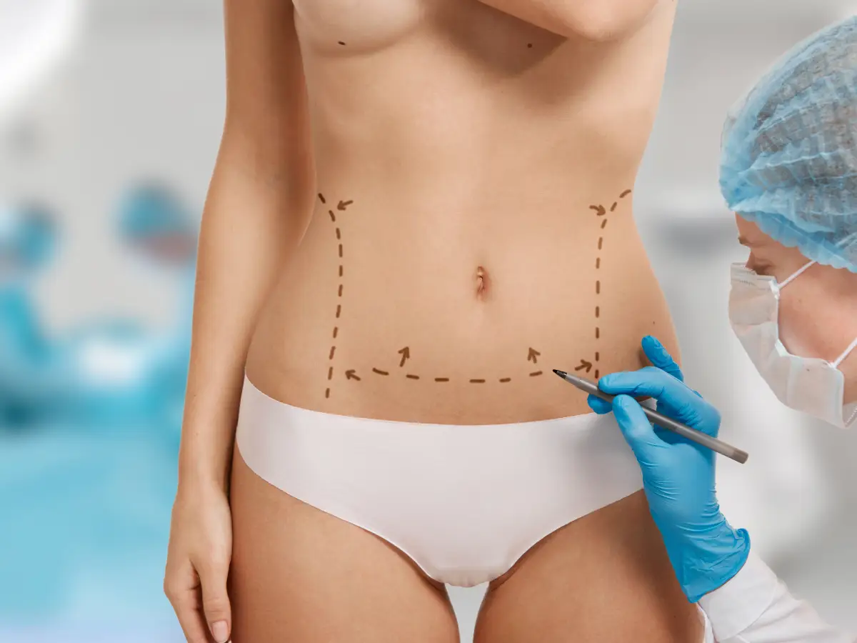 tummy tuck